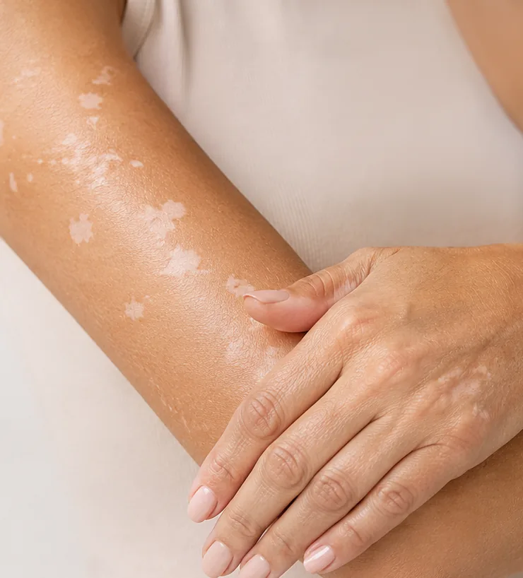 Peau présentant un vitiligo avant application